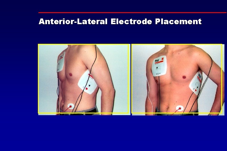Anterior-Lateral Electrode Placement 
