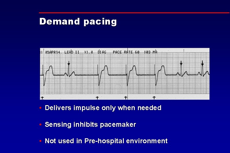 Demand pacing • Delivers impulse only when needed • Sensing inhibits pacemaker • Not