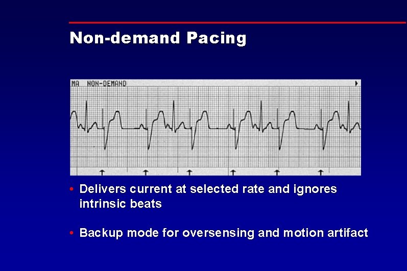 Non-demand Pacing • Delivers current at selected rate and ignores intrinsic beats • Backup