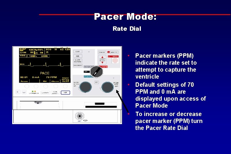 Pacer Mode: Rate Dial • Pacer markers (PPM) indicate the rate set to attempt