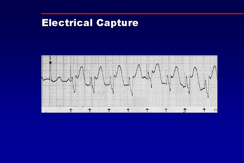 Electrical Capture 