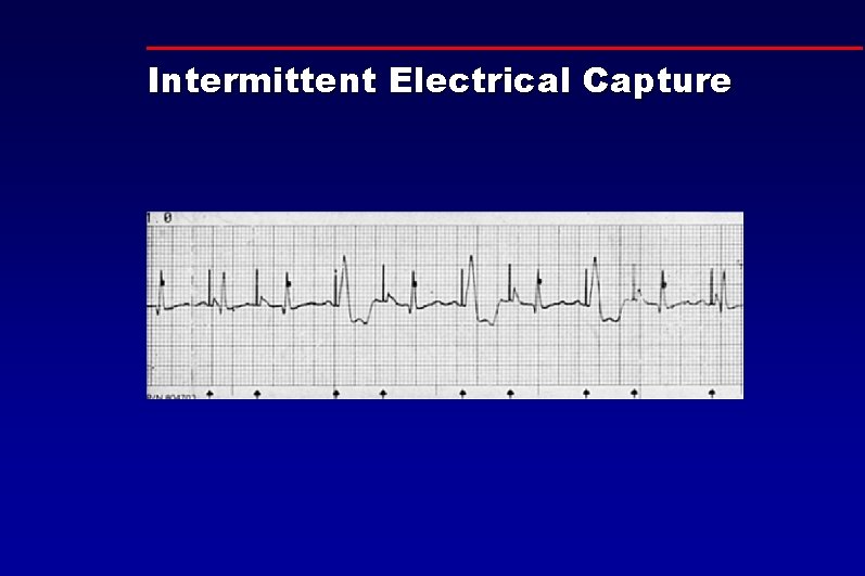 Intermittent Electrical Capture 