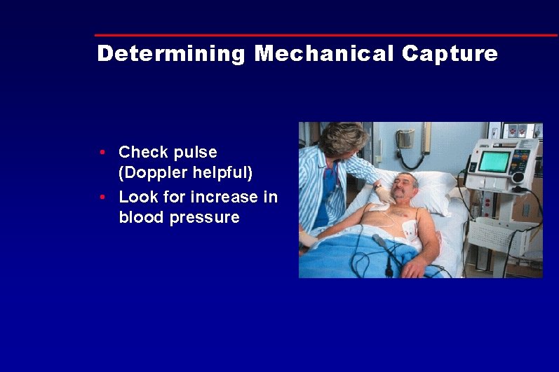 Determining Mechanical Capture • Check pulse (Doppler helpful) • Look for increase in blood