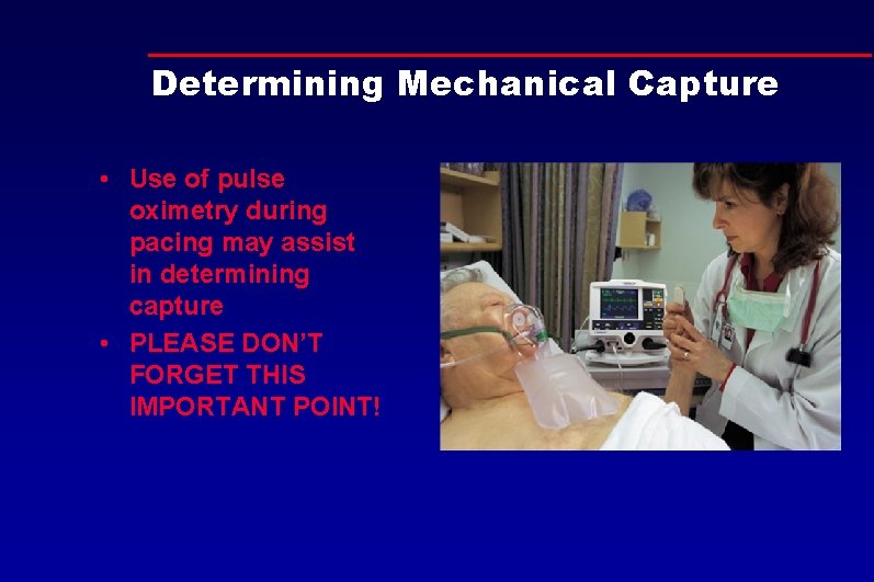 Determining Mechanical Capture • Use of pulse oximetry during pacing may assist in determining