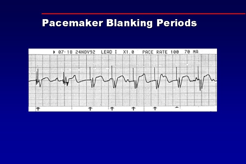 Pacemaker Blanking Periods 