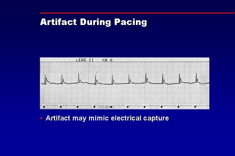 Artifact During Pacing • Artifact may mimic electrical capture 