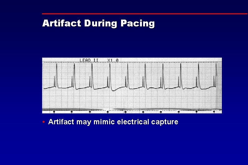 Artifact During Pacing • Artifact may mimic electrical capture 