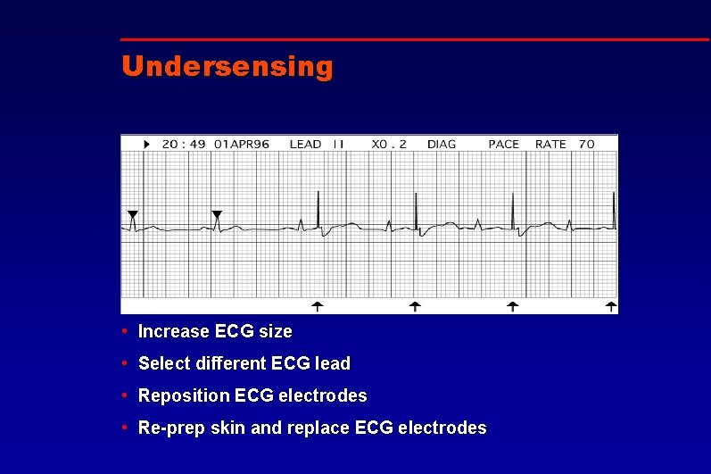 Undersensing • Increase ECG size • Select different ECG lead • Reposition ECG electrodes