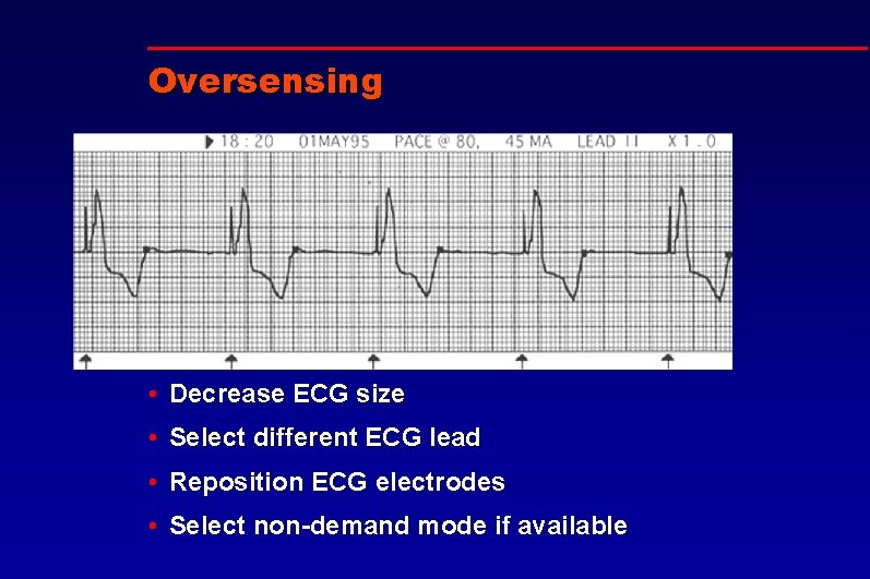 Oversensing • Decrease ECG size • Select different ECG lead • Reposition ECG electrodes