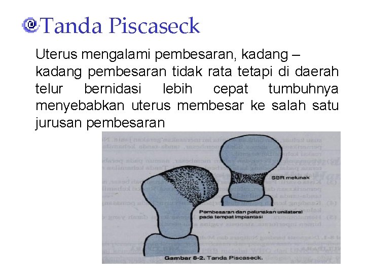 Tanda Piscaseck Uterus mengalami pembesaran, kadang – kadang pembesaran tidak rata tetapi di daerah