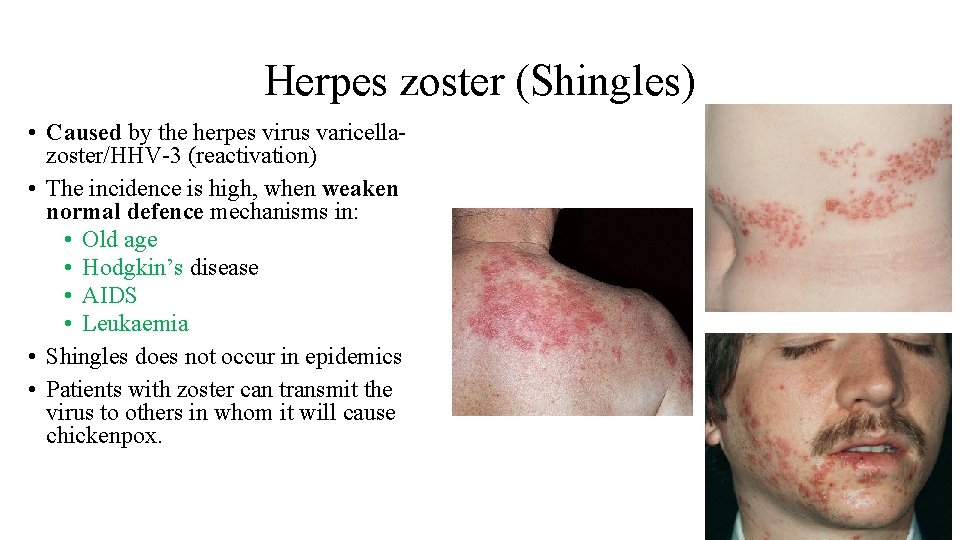 Herpes zoster (Shingles) • Caused by the herpes virus varicellazoster/HHV-3 (reactivation) • The incidence