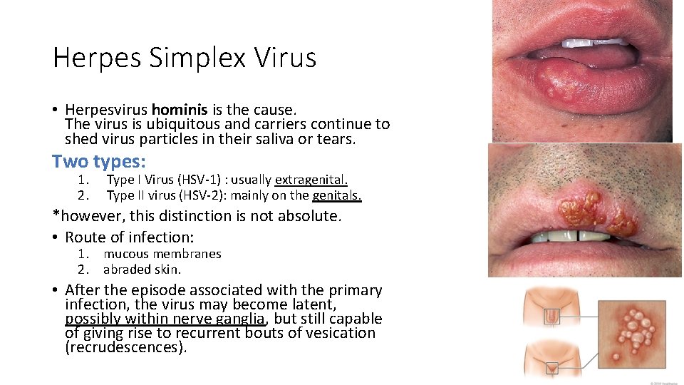 Herpes Simplex Virus • Herpesvirus hominis is the cause. The virus is ubiquitous and