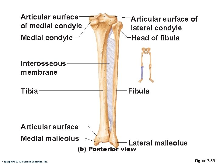 Articular surface of medial condyle Medial condyle Articular surface of lateral condyle Head of