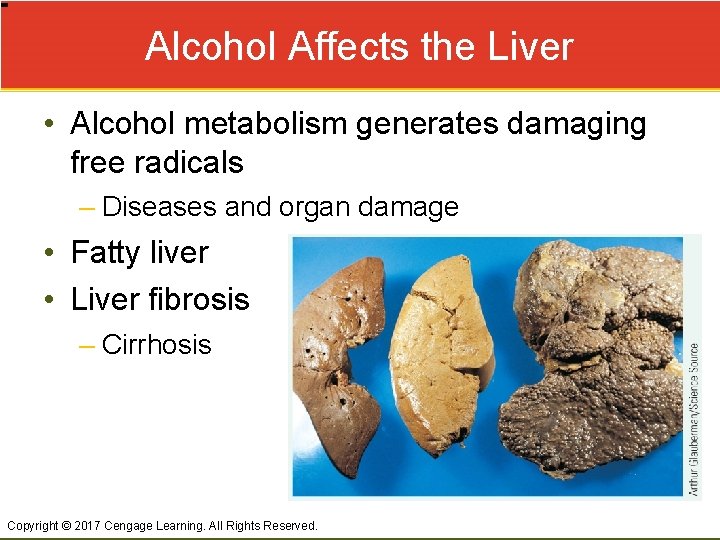 Alcohol Affects the Liver • Alcohol metabolism generates damaging free radicals – Diseases and