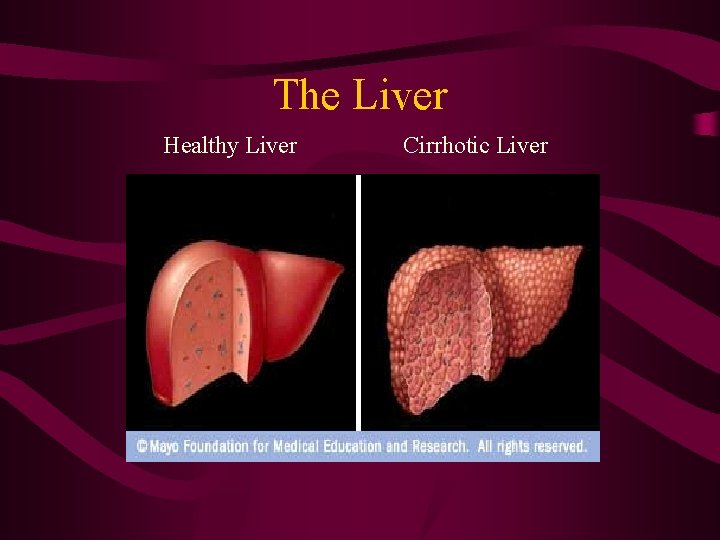 The Liver Healthy Liver Cirrhotic Liver 