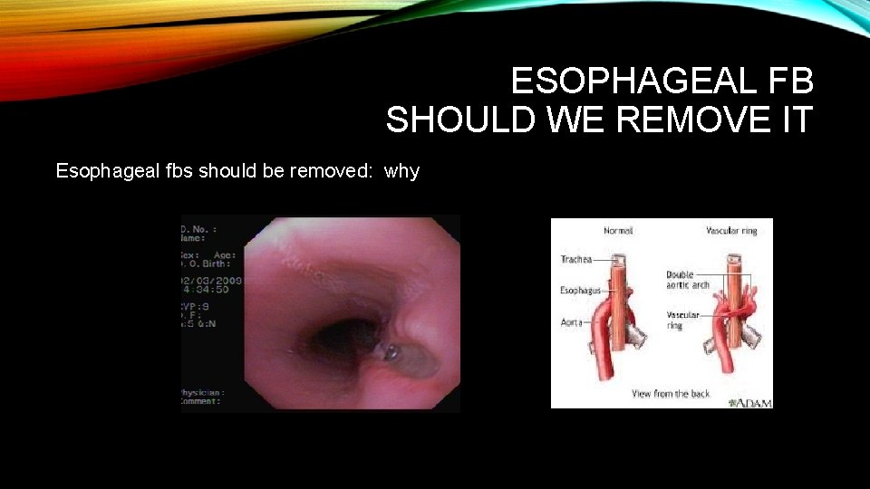ESOPHAGEAL FB SHOULD WE REMOVE IT Esophageal fbs should be removed: why 