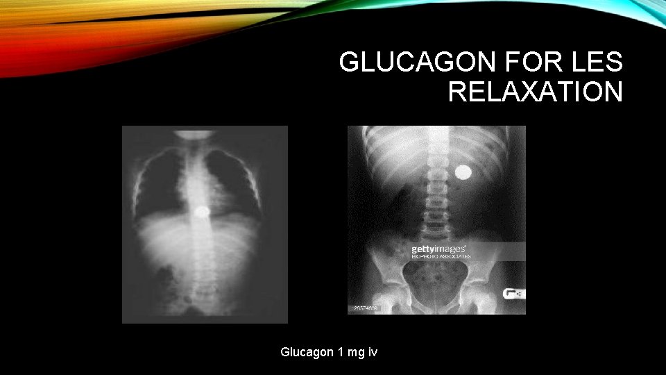 GLUCAGON FOR LES RELAXATION Glucagon 1 mg iv 