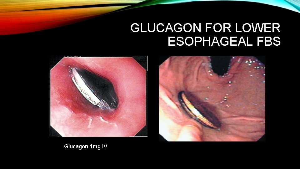 GLUCAGON FOR LOWER ESOPHAGEAL FBS Glucagon 1 mg IV 