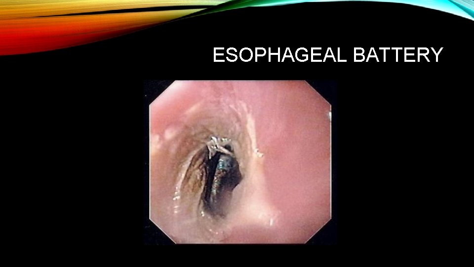 ESOPHAGEAL BATTERY 