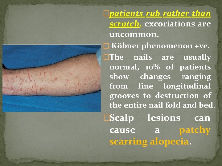 �patients rub rather than scratch, excoriations are uncommon. � Köbner phenomenon +ve. �The nails