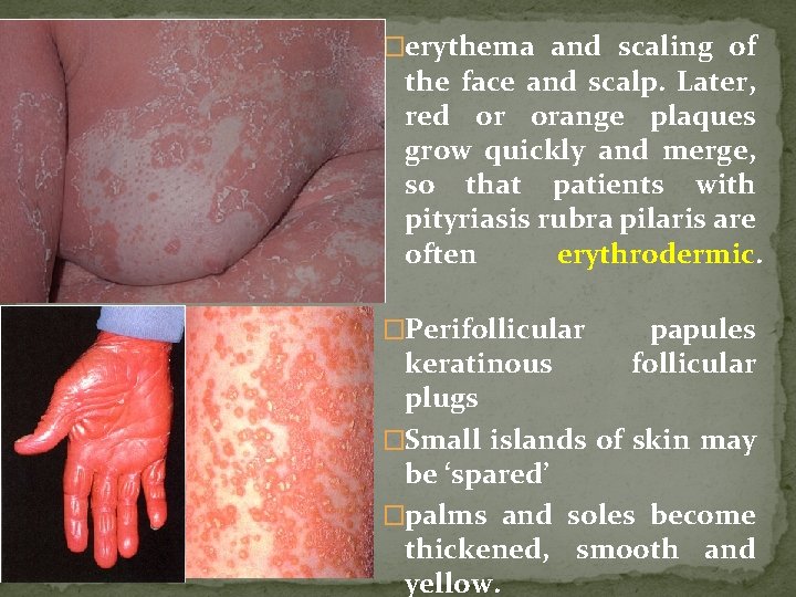 �erythema and scaling of the face and scalp. Later, red or orange plaques grow