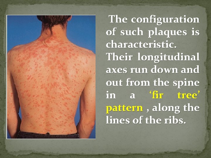 The configuration of such plaques is characteristic. Their longitudinal axes run down and out