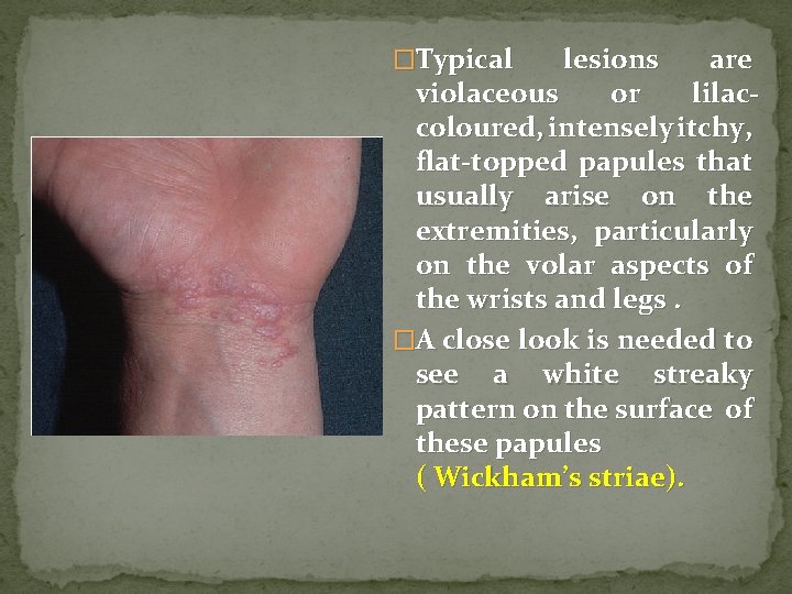 �Typical lesions are violaceous or lilaccoloured, intensely itchy, flat-topped papules that usually arise on