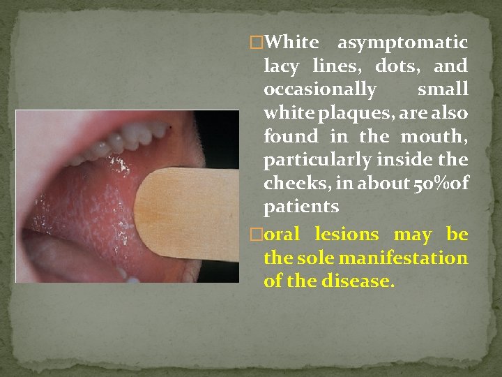 �White asymptomatic lacy lines, dots, and occasionally small white plaques, are also found in