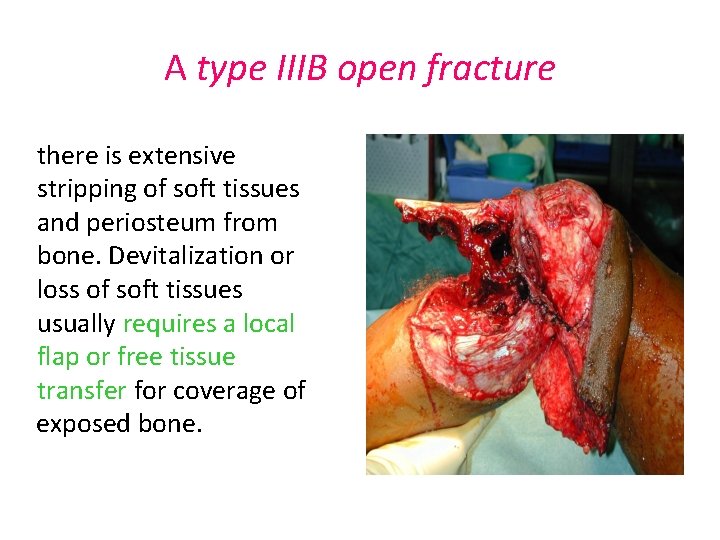 A type IIIB open fracture there is extensive stripping of soft tissues and periosteum