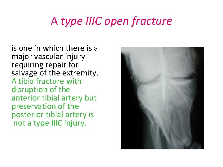 A type IIIC open fracture is one in which there is a major vascular