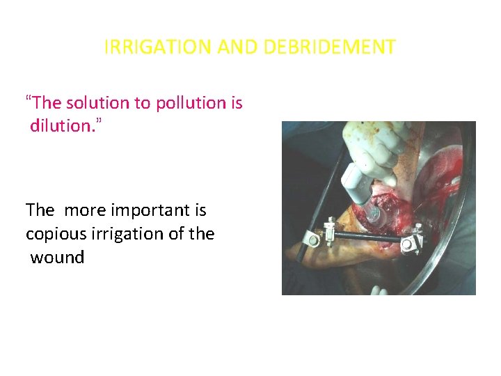 IRRIGATION AND DEBRIDEMENT “The solution to pollution is dilution. ” The more important is