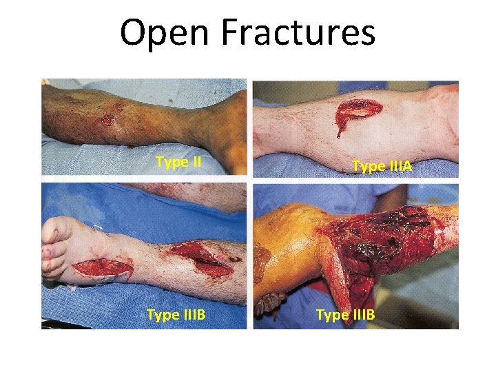 Open Fractures Type IIIB Type IIIA Type IIIB 