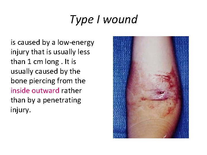 Type I wound is caused by a low-energy injury that is usually less than
