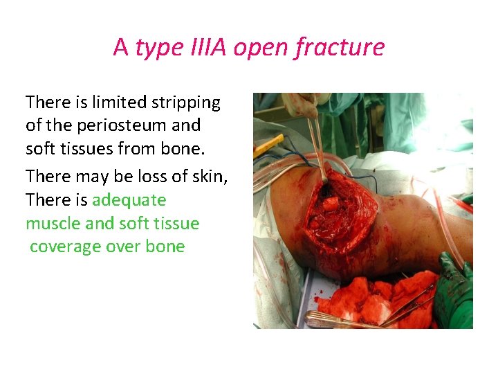 A type IIIA open fracture There is limited stripping of the periosteum and soft