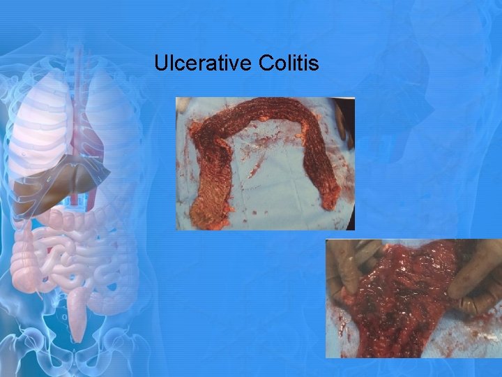 Ulcerative Colitis 