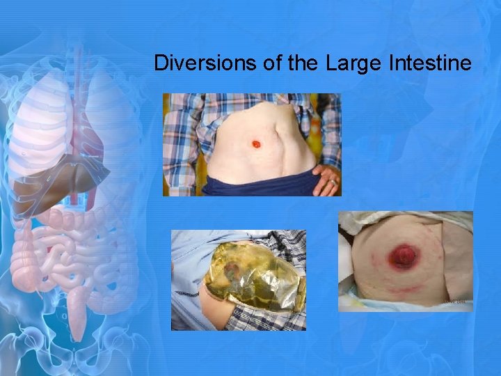 Diversions of the Large Intestine 