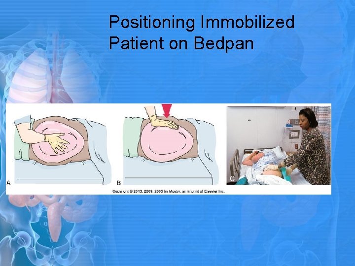 Positioning Immobilized Patient on Bedpan 