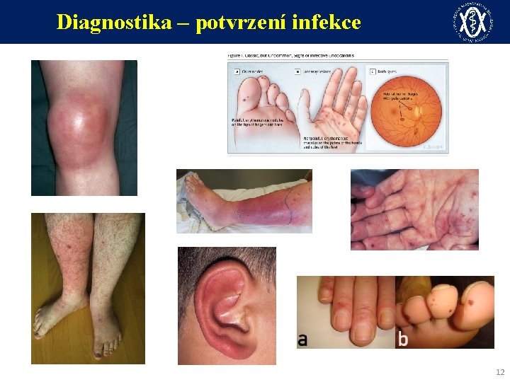 Diagnostika – potvrzení infekce 12 