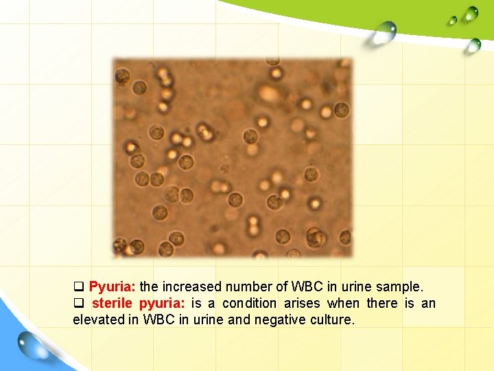 q Pyuria: the increased number of WBC in urine sample. q sterile pyuria: is