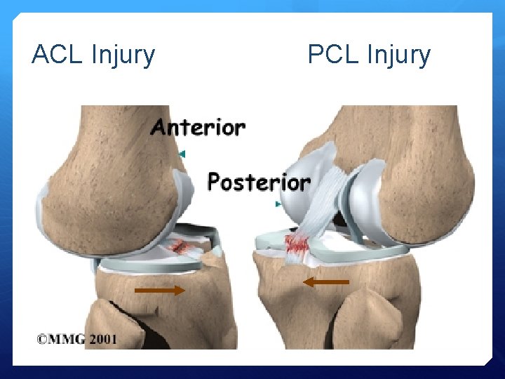 ACL Injury PCL Injury 