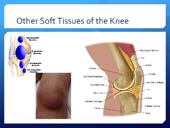 Other Soft Tissues of the Knee 