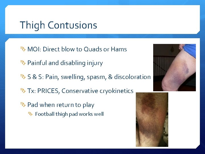 Thigh Contusions MOI: Direct blow to Quads or Hams Painful and disabling injury S