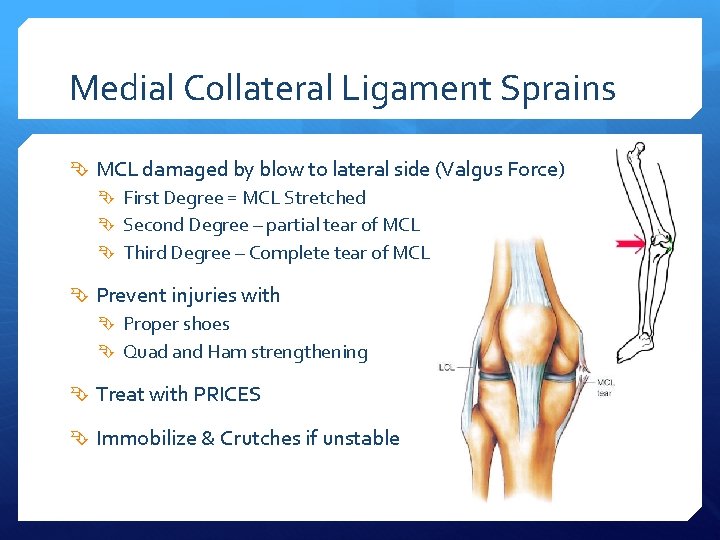Medial Collateral Ligament Sprains MCL damaged by blow to lateral side (Valgus Force) First