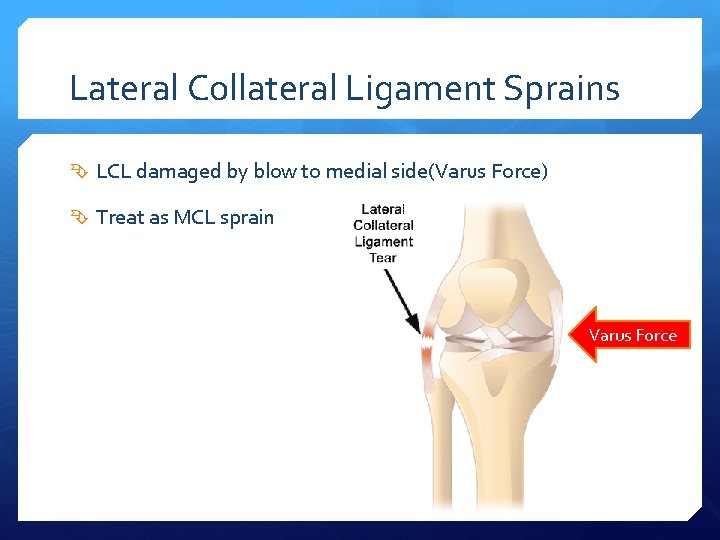 Lateral Collateral Ligament Sprains LCL damaged by blow to medial side(Varus Force) Treat as