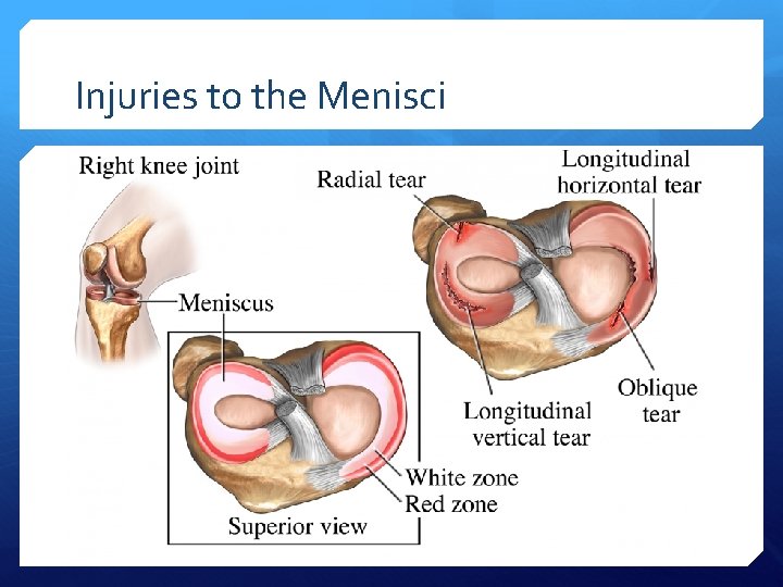 Injuries to the Menisci 