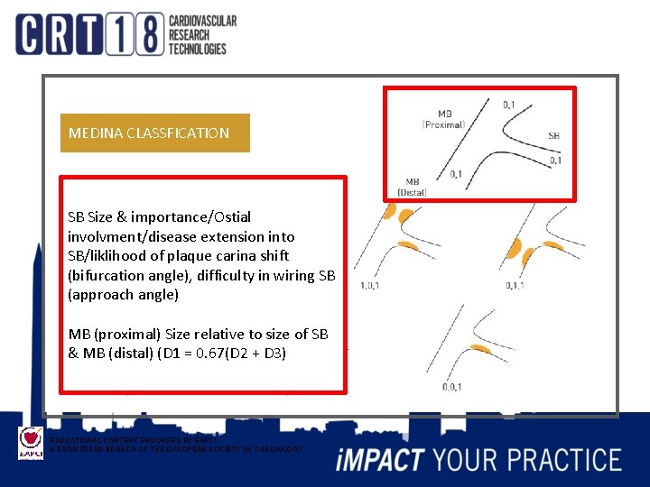 MEDINA CLASSFICATION SB Size & importance/Ostial involvment/disease extension into SB/liklihood of plaque carina shift