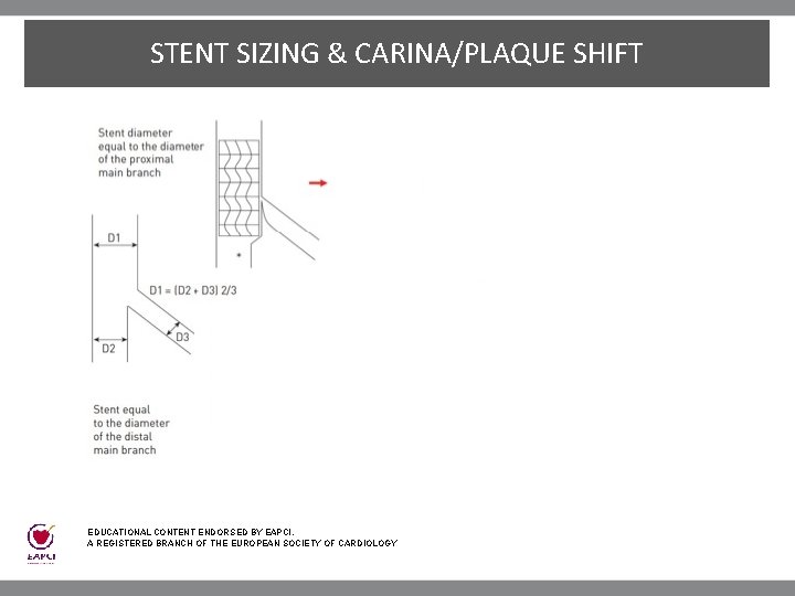 STENT SIZING & CARINA/PLAQUE SHIFT EDUCATIONAL CONTENT ENDORSED BY EAPCI, A REGISTERED BRANCH OF