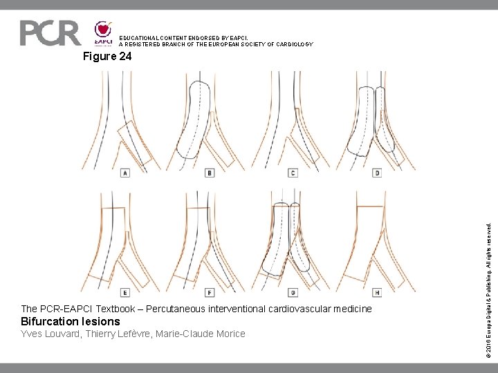 EDUCATIONAL CONTENT ENDORSED BY EAPCI, A REGISTERED BRANCH OF THE EUROPEAN SOCIETY OF CARDIOLOGY