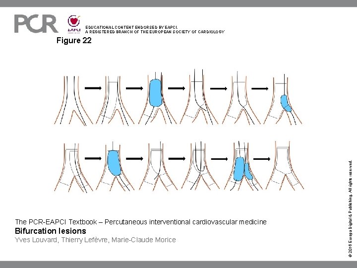 EDUCATIONAL CONTENT ENDORSED BY EAPCI, A REGISTERED BRANCH OF THE EUROPEAN SOCIETY OF CARDIOLOGY