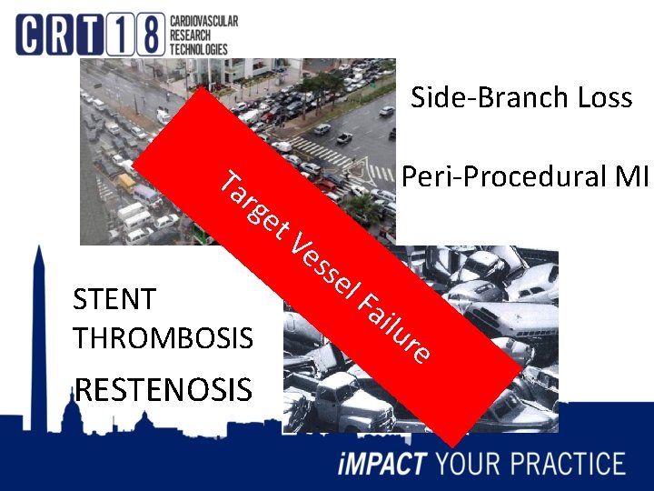 Side-Branch Loss Ta r ge Peri-Procedural MI STENT THROMBOSIS RESTENOSIS t. V es se